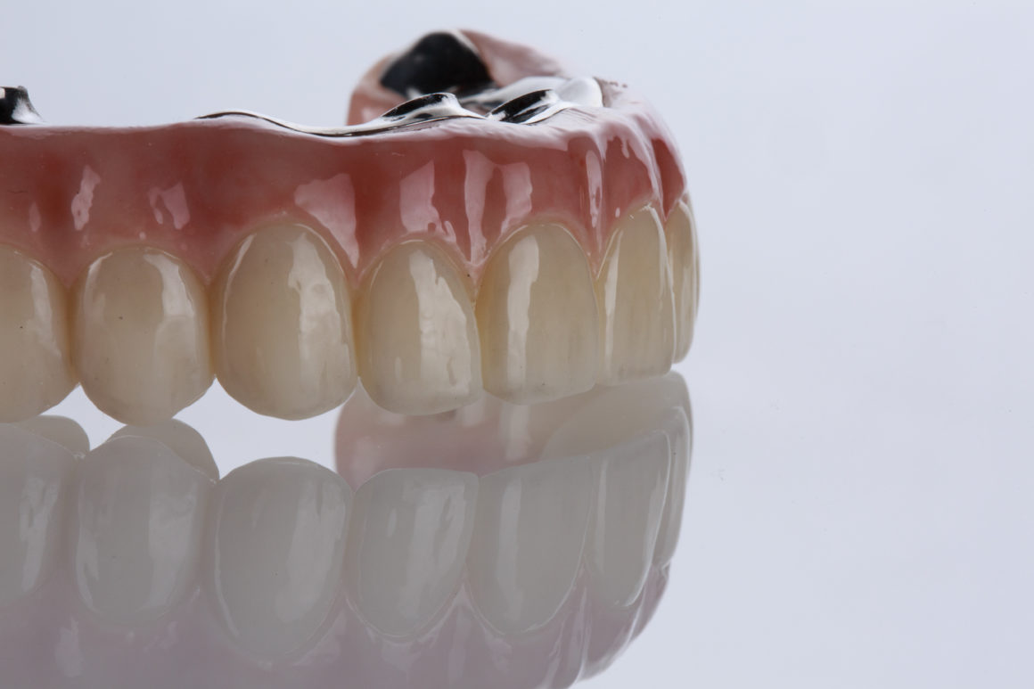 Відновлення зубного ряду на 4 або 6 імплантах (All-on-4 / All-on-6)