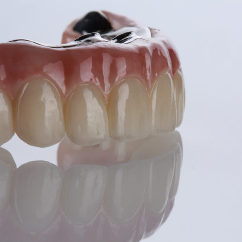 Відновлення зубного ряду на 4 або 6 імплантах (All-on-4 / All-on-6)