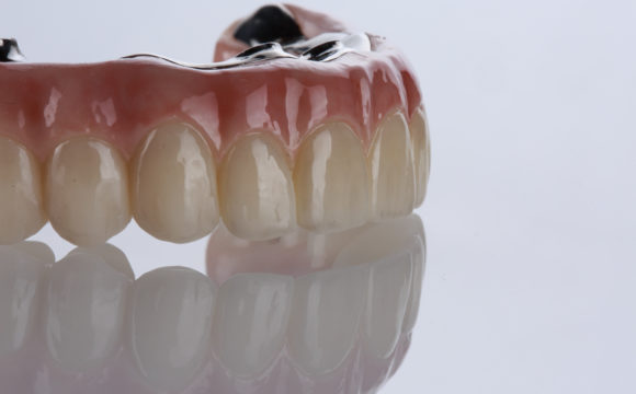 Відновлення зубного ряду на 4 або 6 імплантах (All-on-4 / All-on-6)