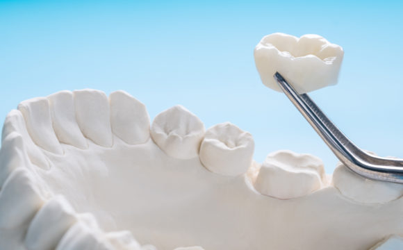 Цирконієві чи металокерамічні коронки: що обрати?