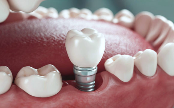 Одномоментна імплантація в клініці О’Доктор