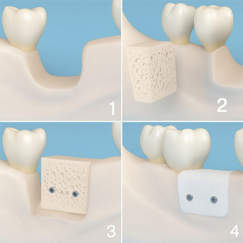 Кісткова аугментація в клініці O-Doctor