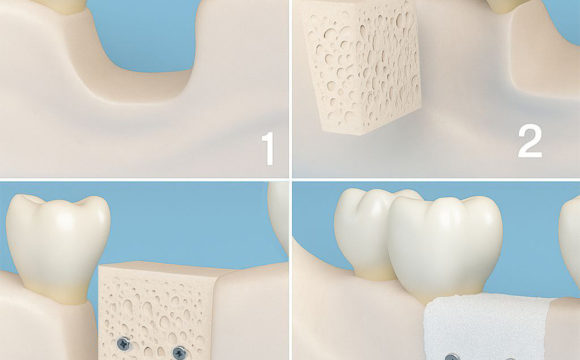 Кісткова аугментація в клініці O-Doctor