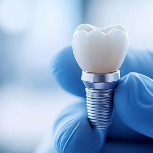 Як доглядати за зубними імплантами після операції: поради пацієнтам