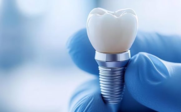 Як доглядати за зубними імплантами після операції: поради пацієнтам